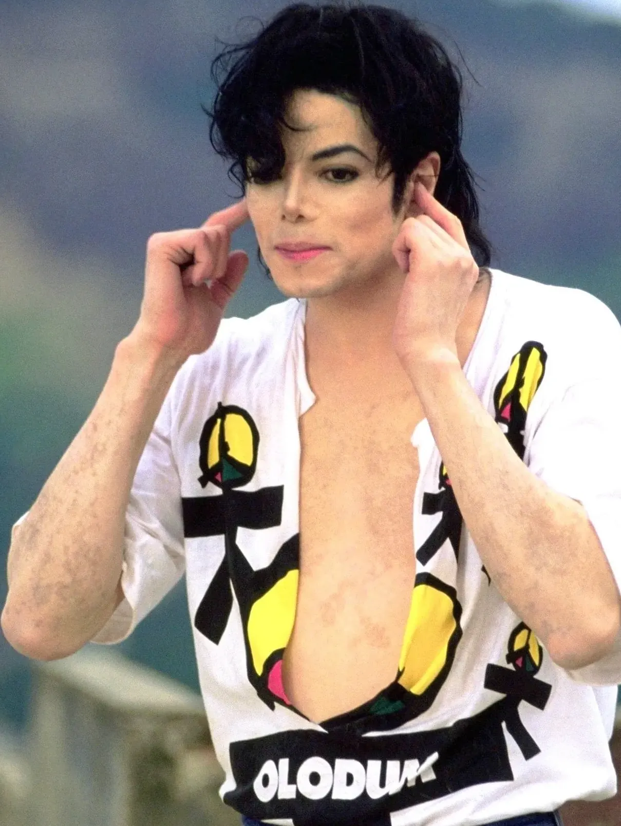 mj tdcau vitiligo 1995