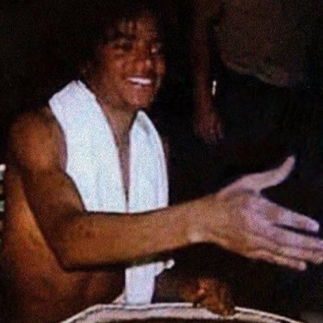 mj vitiligo hand