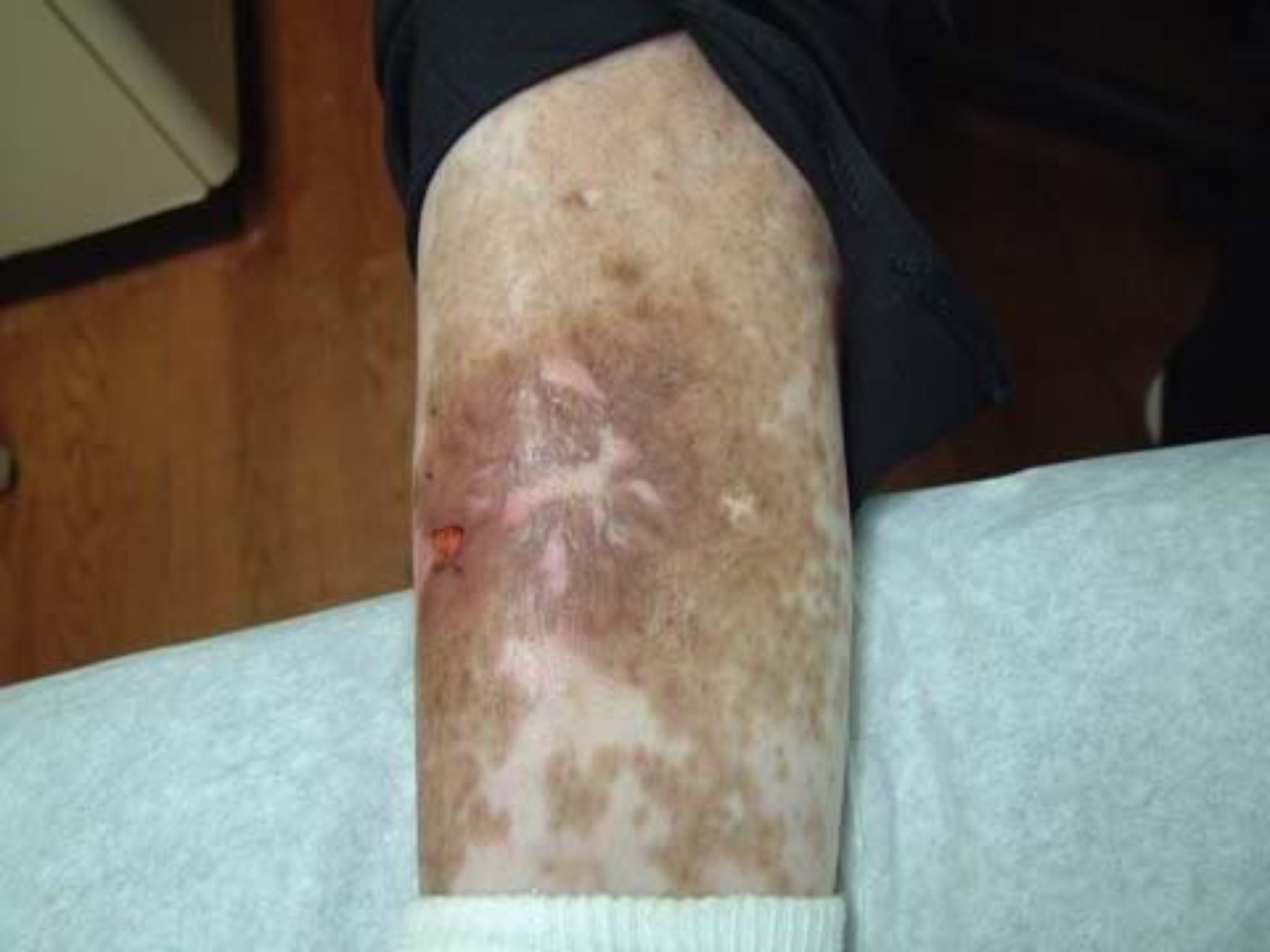 Michael Jackson vitiligo + spider bite 2003