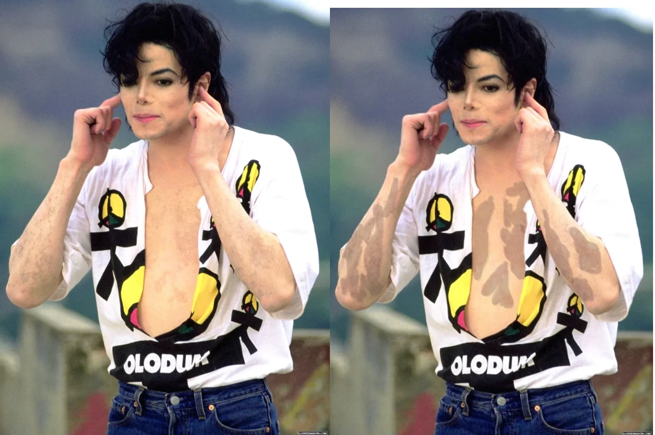 Photo Explainer Vitiligo