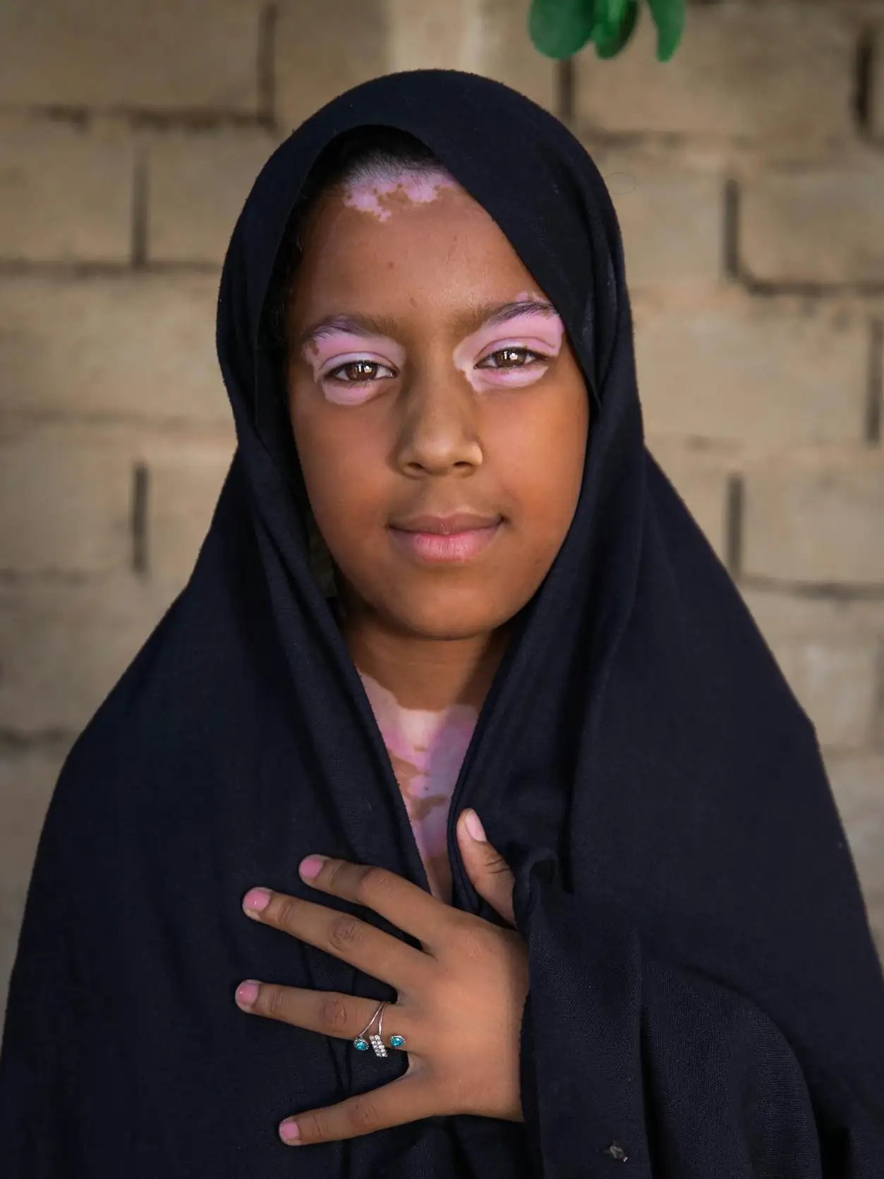 Child with vitiligo Pexels Zaid Mohammed