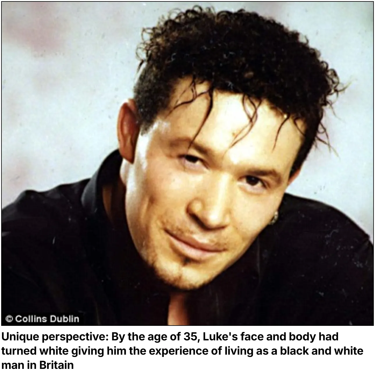 Luke David vitiligo adult
