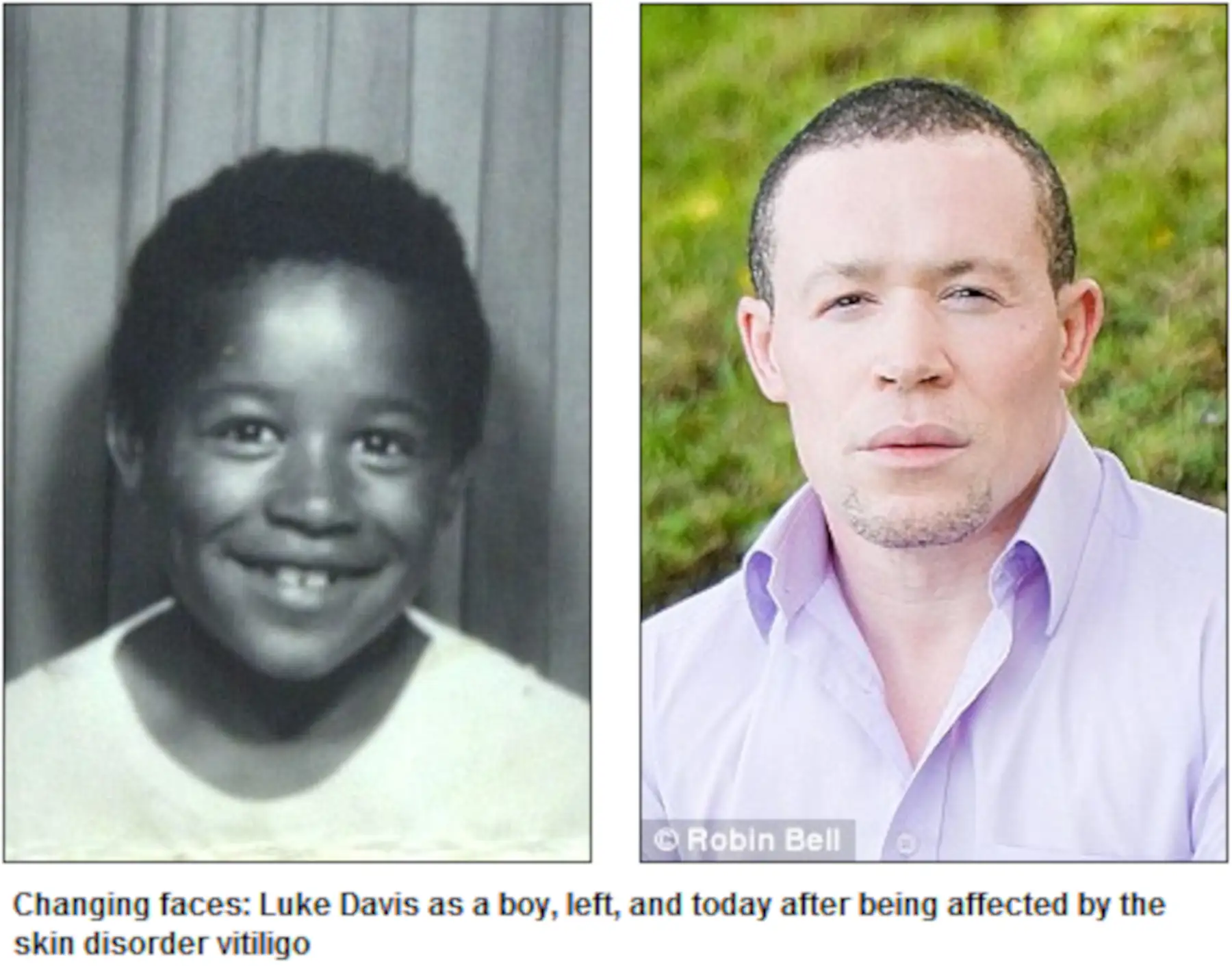 Luke Davis vitiligo child to adult