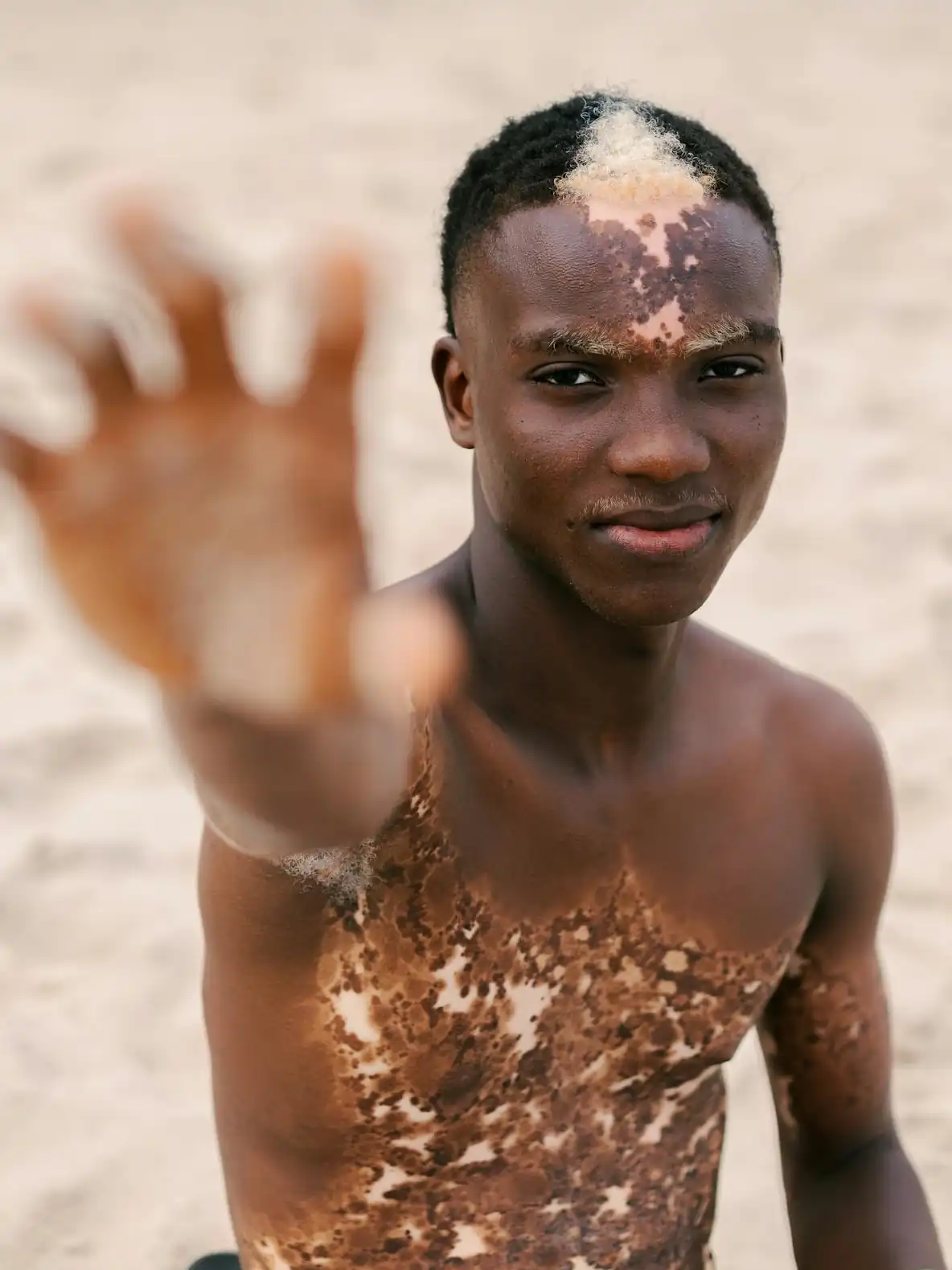 Young Man Extending His Hand vitiligo Pexels Ben Iwara