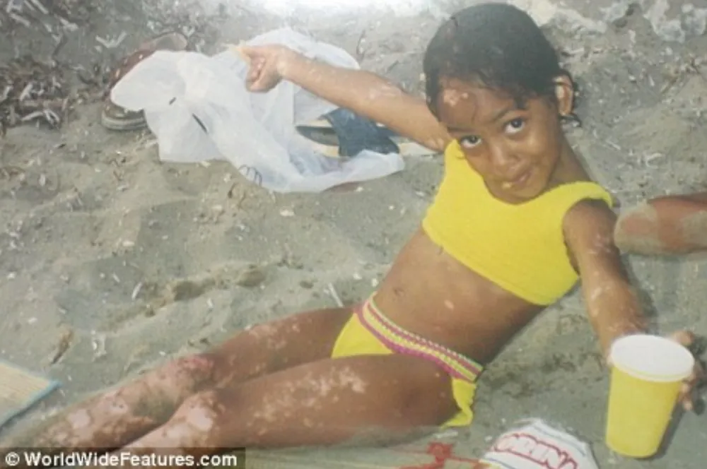 Darlene de Vlugt vitiligo kid