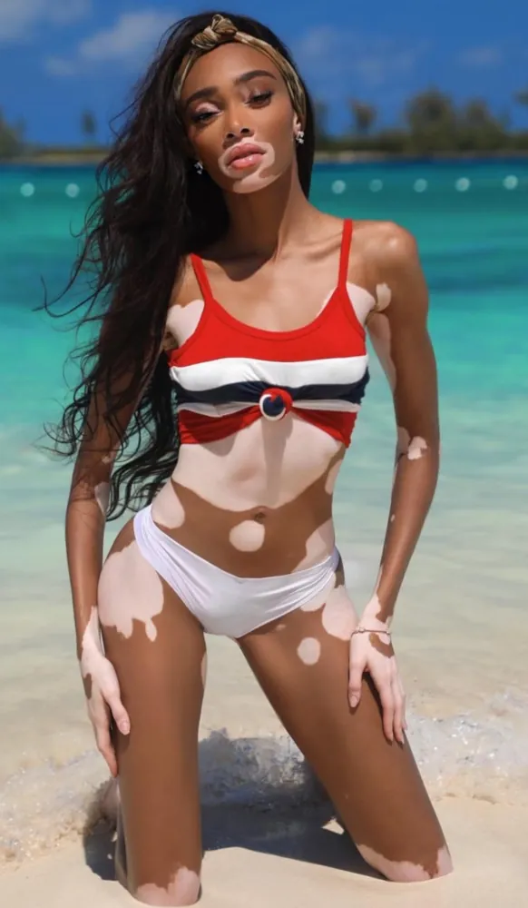 Winnie Harlow vitiligo Insta 15.3.2019