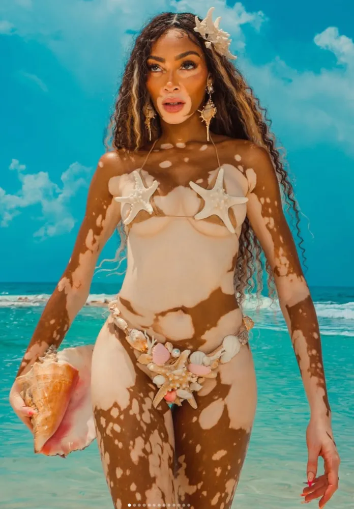 Winnie Harlow vitiligo Insta post 29.8.24