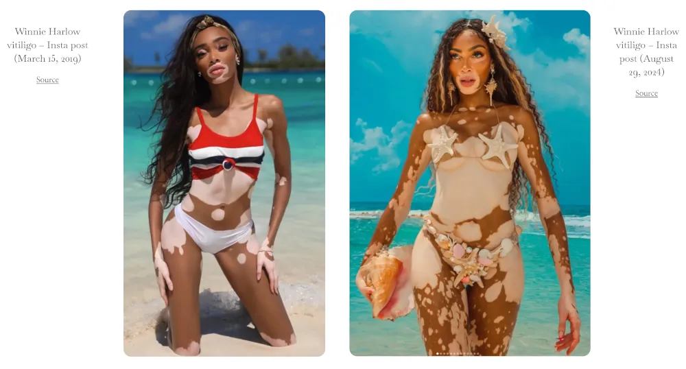 Winnie Harlow vitiligo